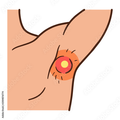 Canvastavla Illustration of a Skin Abscess or Inflamed Boil in the Armpit Area