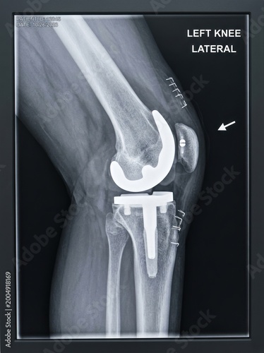 A lateral X-ray image displays a left knee with a total knee replacement. The image shows the femur, tibia, and patella, all replaced with metallic implants.