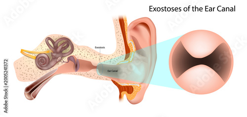 Tableau sur toile Exostoses of the Ear Canal with Auditory Canal Narrowing Medical Illustration