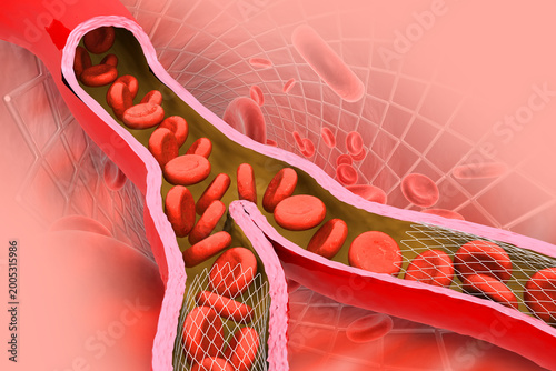 Balloon angioplasty procedure with stent in vein.3d illustration