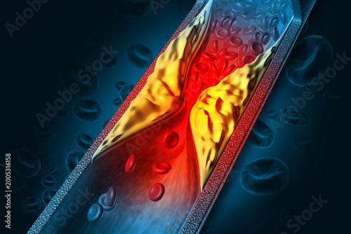 Cholesterol blocked artery. The accumulation of cholesterol in the blood vessels. Stent angioplasty. 3d illustration