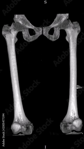 3D CT scan femur gunshot wound. Medical imaging showing projectile impact on left thigh bone structure for clinical analysis forensic science and surgical planning education.
