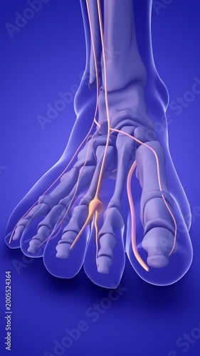 A Morton's neuroma on a foot nerve