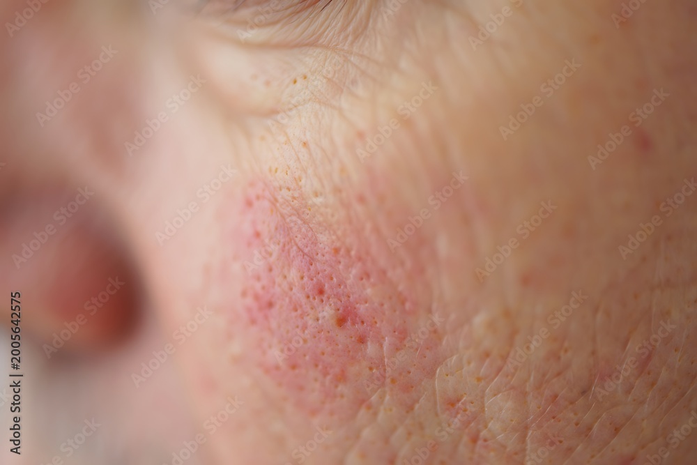 Fototapeta premium Extreme close up of human skin texture with red rash and visible pores macro