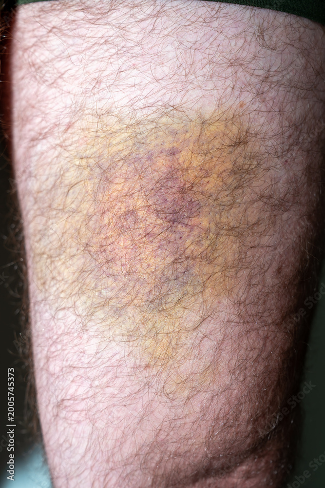 Naklejka premium Large hematoma bruise on human thigh