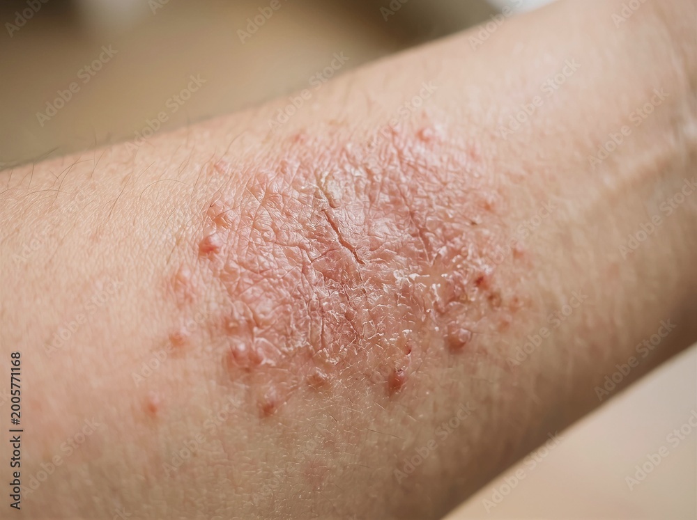 Fototapeta premium Close-up of red irritated skin rash on human forearm with visible texture and hair