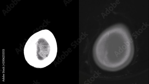 Pediatric hydrocephalus ventriculoperitoneal shunt brain scan. Medical 3D imaging showing surgical treatment progress for infant brain health management in diagnostic radiology clinic