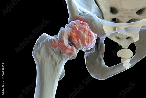 Fotografie Advanced hip osteoarthritis with severe joint space narrowing, large osteophytes