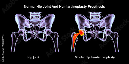 Foto Normal healthy hip joint with intact femoral head, and acetabulum, and bipolar hemiarthroplasty prosthesis with dual mobility femoral head and femoral stem, 3D illustration
