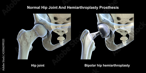 Schilderij op canvas Normal healthy hip joint with intact femoral head, and acetabulum, and bipolar hemiarthroplasty prosthesis with dual mobility femoral head and femoral stem, 3D illustration