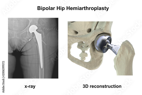 X-ray of bipolar hemiarthroplasty prosthesis in a female patient after femoral neck fracture, with 3D illustration showing dual mobility femoral head, stem and implant position in the hip joint