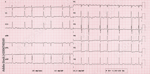 Fotografía Electrocardiogram Showing Atrial Flutter and Atrial Fibrillation on ECG Trace