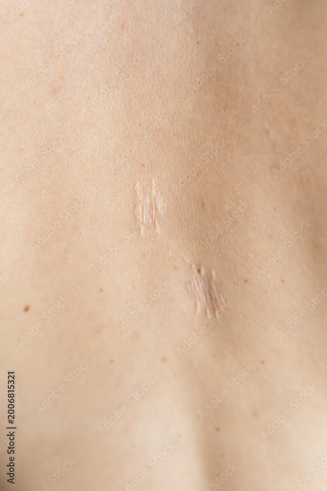 Fototapeta premium Scars on the skin due to wound dehiscence, mole removal