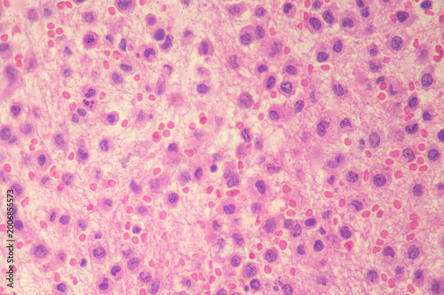 Medical themes: Microscopic image of a rhabdoid sarcoma