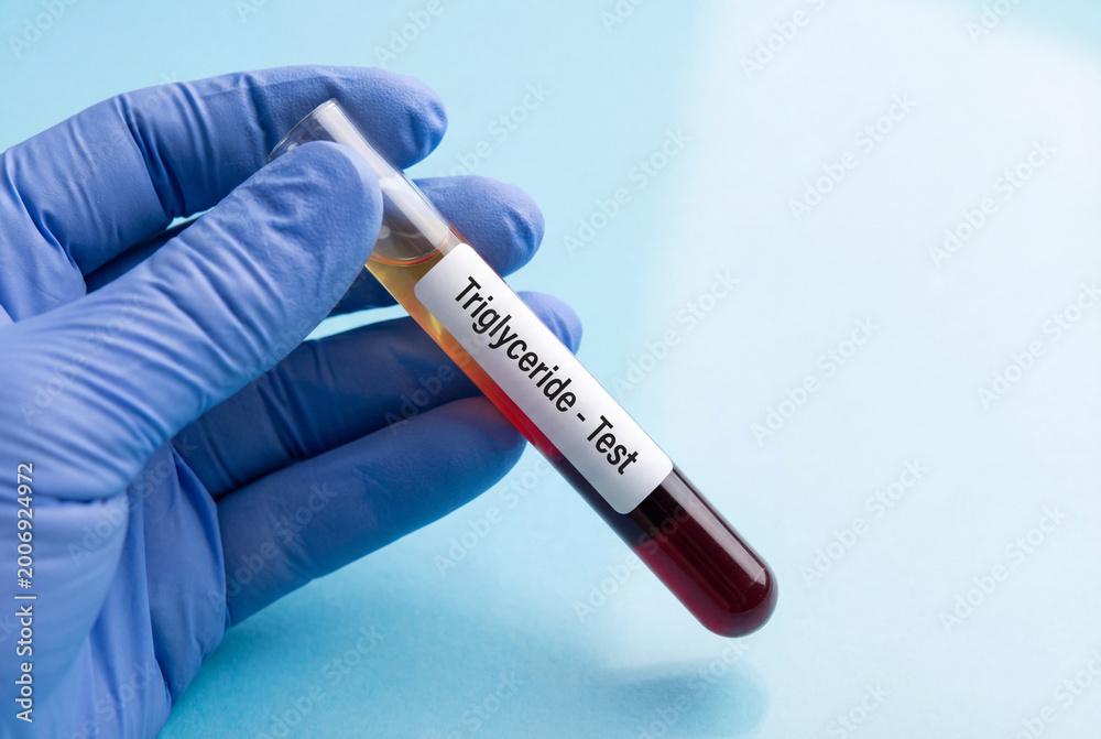 Obraz premium Doctor gloved hand holding a test tube labeled triglyceride test for diagnosis