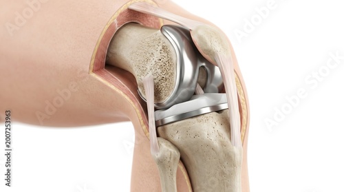 Total knee replacement surgery implant showing artificial joint prosthesis medical illustration
