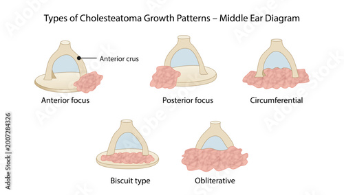 Fotografie Types of Cholesteatoma Growth Patterns – Middle Ear Diagram
cholesteatoma growth patterns including anterior, posterior, circumferential, biscuit type, and obliterative forms in the middle ear