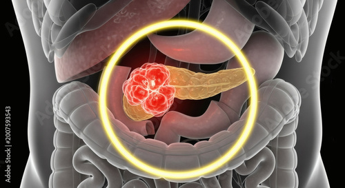 3D Illustration Of Pancreatic Cancer Tumor In Human Abdomen