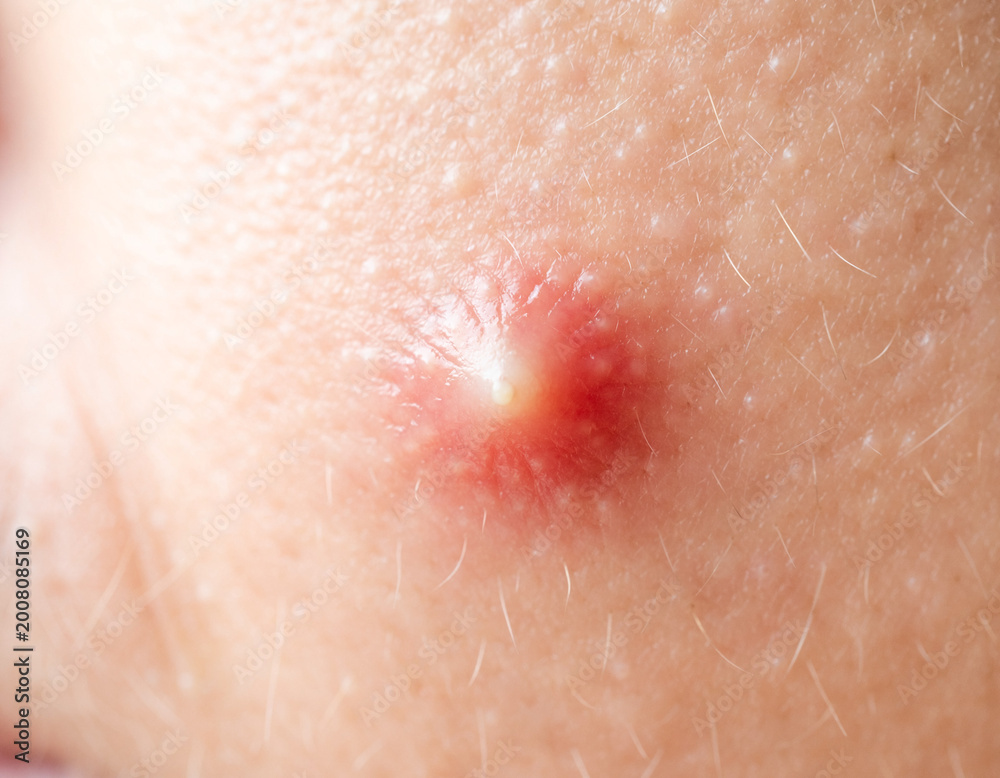 Fototapeta premium Person with acne spot on cheek close to the skin showing detail of a pimple during a daily routine in natural light