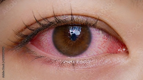 Close up red irritated eye with visible veins dryness allergy infection concept.