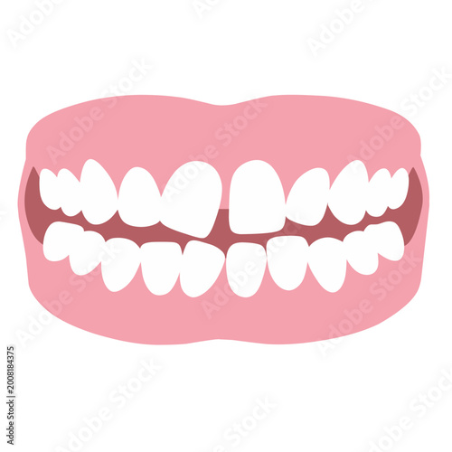 Crooked Teeth and Gaps Misaligned Teeth Malocclusion Illustration