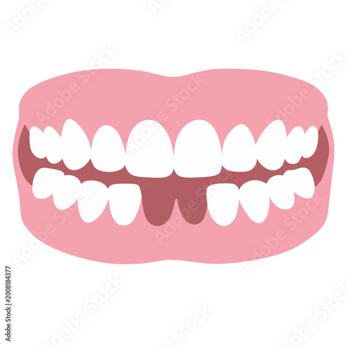 Illustration of Dentures with Missing Teeth
