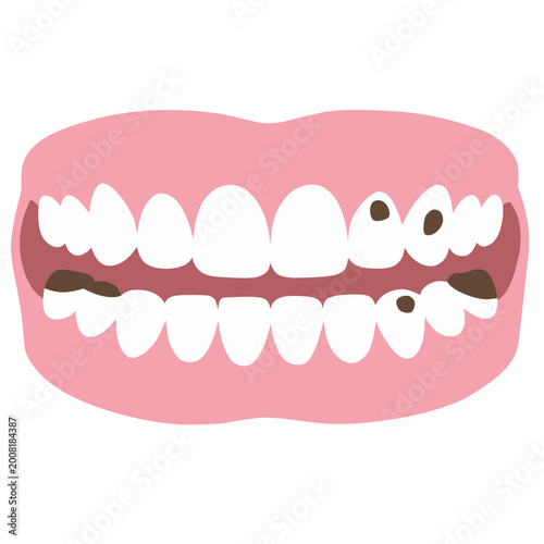 Cavities Teeth Tooth Decay Illustration