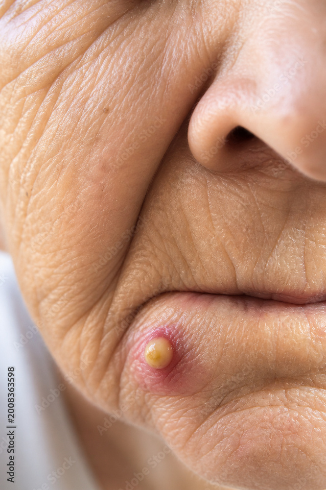 Naklejka premium Macro close-up of mature Caucasian woman with light skin, wrinkles and inflamed chin pustule, natural texture, soft light, dermatology skincare and aging skin concept.