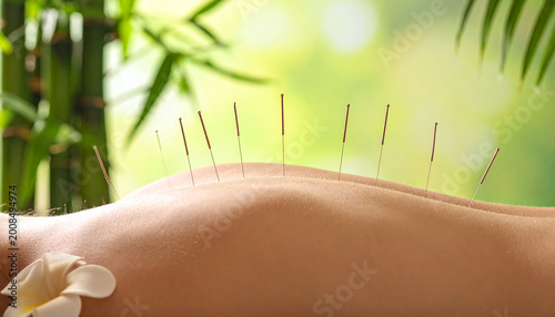 Acupuncture needles in a back  soft spa lighting  zen atmosphere  blurred bamboo back