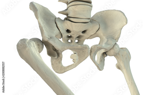 Hip dislocation, 3D illustration showing posterior displacement of the femoral head from the acetabulum, with pelvis and proximal femur, isolated medical depiction of traumatic hip joint injury