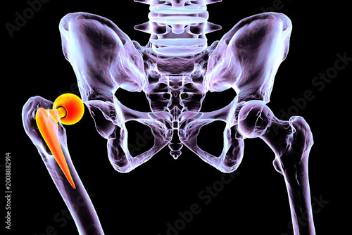 Cuadro en lienzo Posterior dislocation of unipolar hip hemiarthroplasty, 3D illustration showing