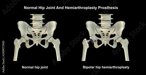 Foto Normal healthy hip joint with intact femoral head, and acetabulum, and bipolar hemiarthroplasty prosthesis with dual mobility femoral head and femoral stem, 3D illustration