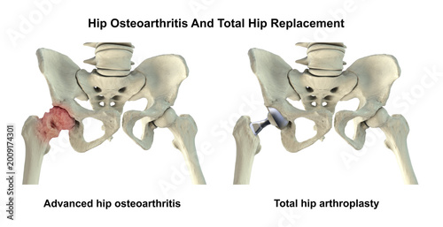 Photos Advanced hip osteoarthritis with joint space narrowing, osteophytes and cartilage loss, and total hip replacement prosthesis, 3D illustration