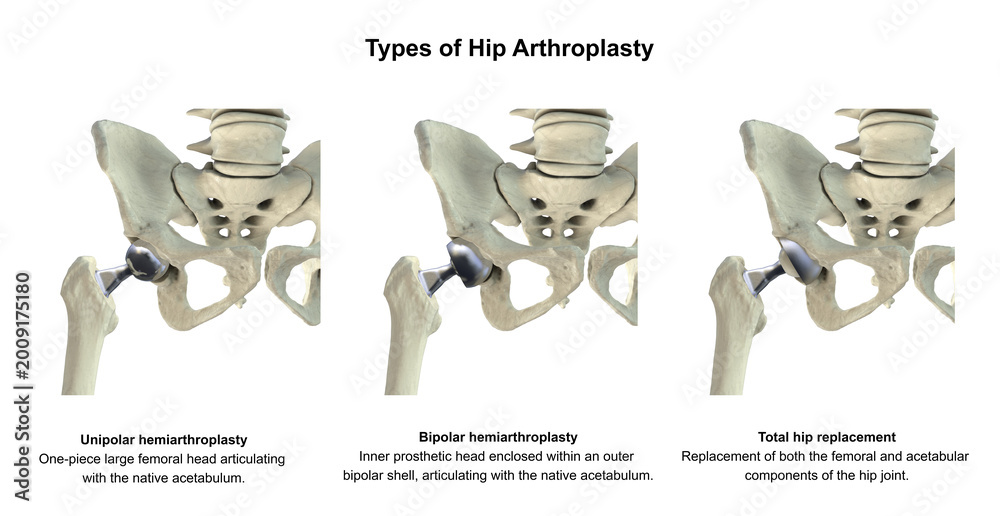 Fototapeta premium Three types of hip prostheses: unipolar hemiarthroplasty, bipolar hemiarthroplasty and total hip replacement, 3D illustration