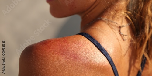 Sunburned Shoulder of Woman in Bikini