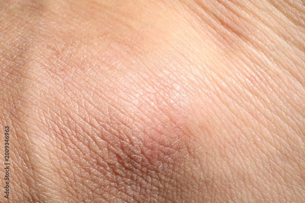 Fototapeta premium Man with dry skin on his hand, closeup