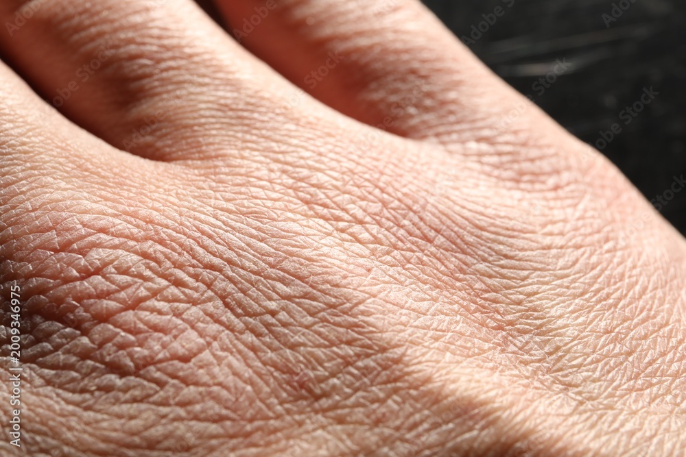 Fototapeta premium Man with dry skin on his hand against blurred background, closeup