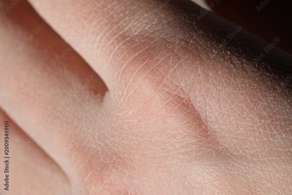 Naklejka premium Man with dry skin on his hand, closeup