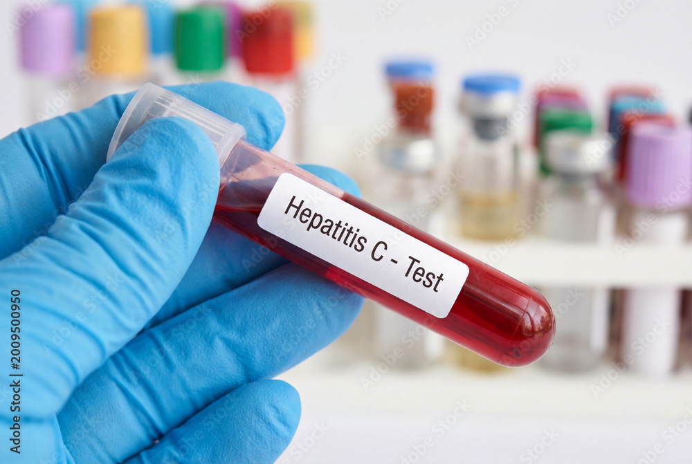Fototapeta premium Doctor holding a blood sample in a test tube for a hepatitis c virus screening