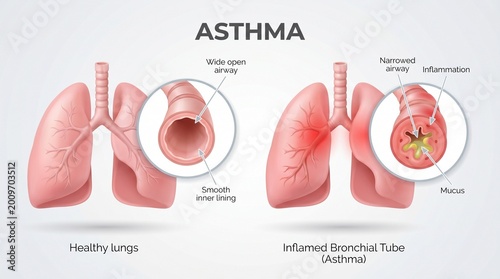 Medical diagram of healthy versus asthmatic human lungs