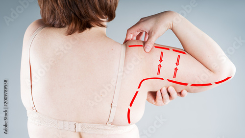 Bild auf Leinwand Woman pinching flabby fat on upper arm with red arrows and surgical lines