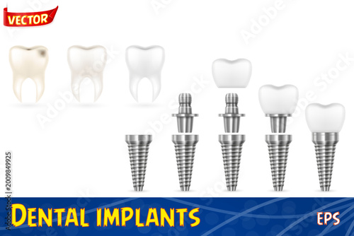 Принти на полотні metal human tooth implant set icons vector illustration