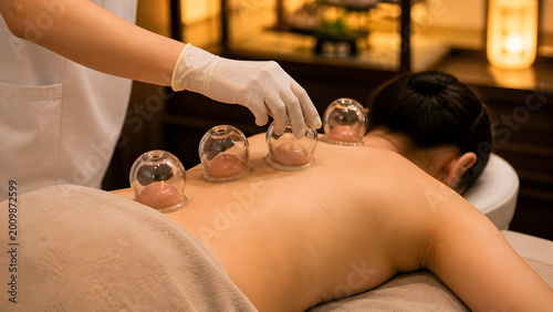 Close-up of glass cupping therapy treatment for back pain relief and wellness