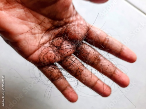 Fotografía Close up of hair loss strands on hand showing hair fall problem and personal hai