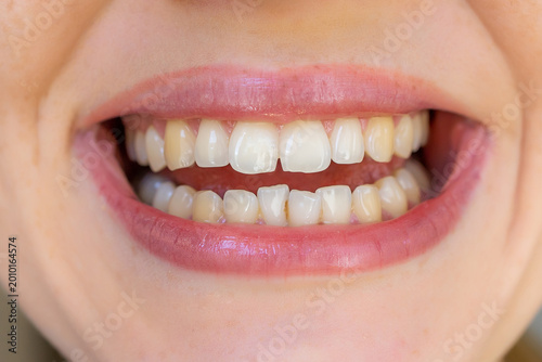 Close-up of teeth showcasing natural tooth coloration and dental alignment