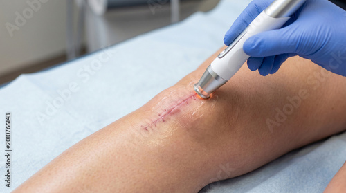 Cold laser therapy applied to knee surgery scar
