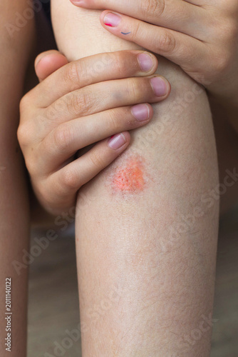 Close up of child hands touching bruise on knee skin after minor injury, natural light medical concept illustrating childhood accident, pain, recovery, healthcare and skin trauma vertical