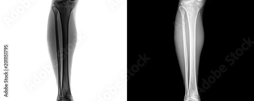 Bild auf Leinwand Diagnostic Leg Anterior Projection X-Ray Image Displaying Bone Structure and Ali