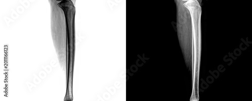 Vászonkép High Quality Leg Lateral Projection X-ray Radiograph Depicting Bone Integrity an