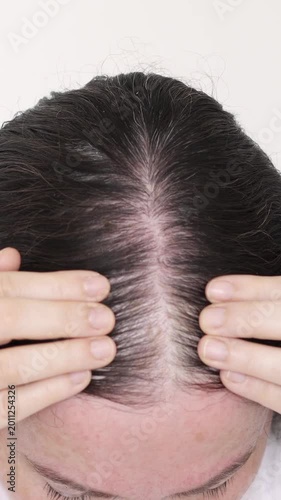 Woman controls hair loss and little volume with fine hair